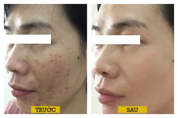 LASER THẨM MỸ